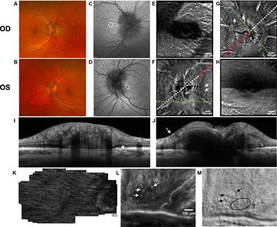 Application of novel non-invasive ophthalmic imaging to visualize peripapillary wrinkles, retinal folds and peripapillary hyperreflective ovoid mass-like structures associated with elevated intracranial pressure